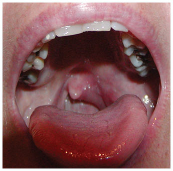 Example of a HAE attack affecting the upper airway