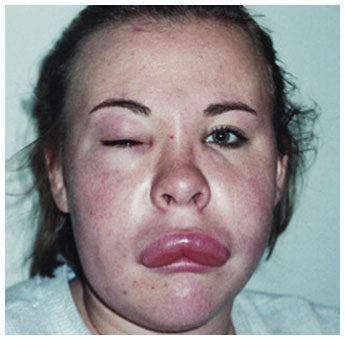 Example of a HAE attack affecting the Skin/Subcutaneous Tissue