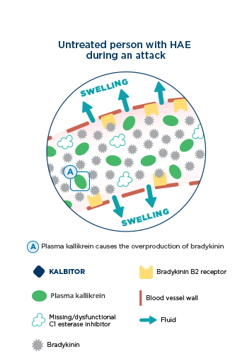 Untreated person with HAE during an attack.